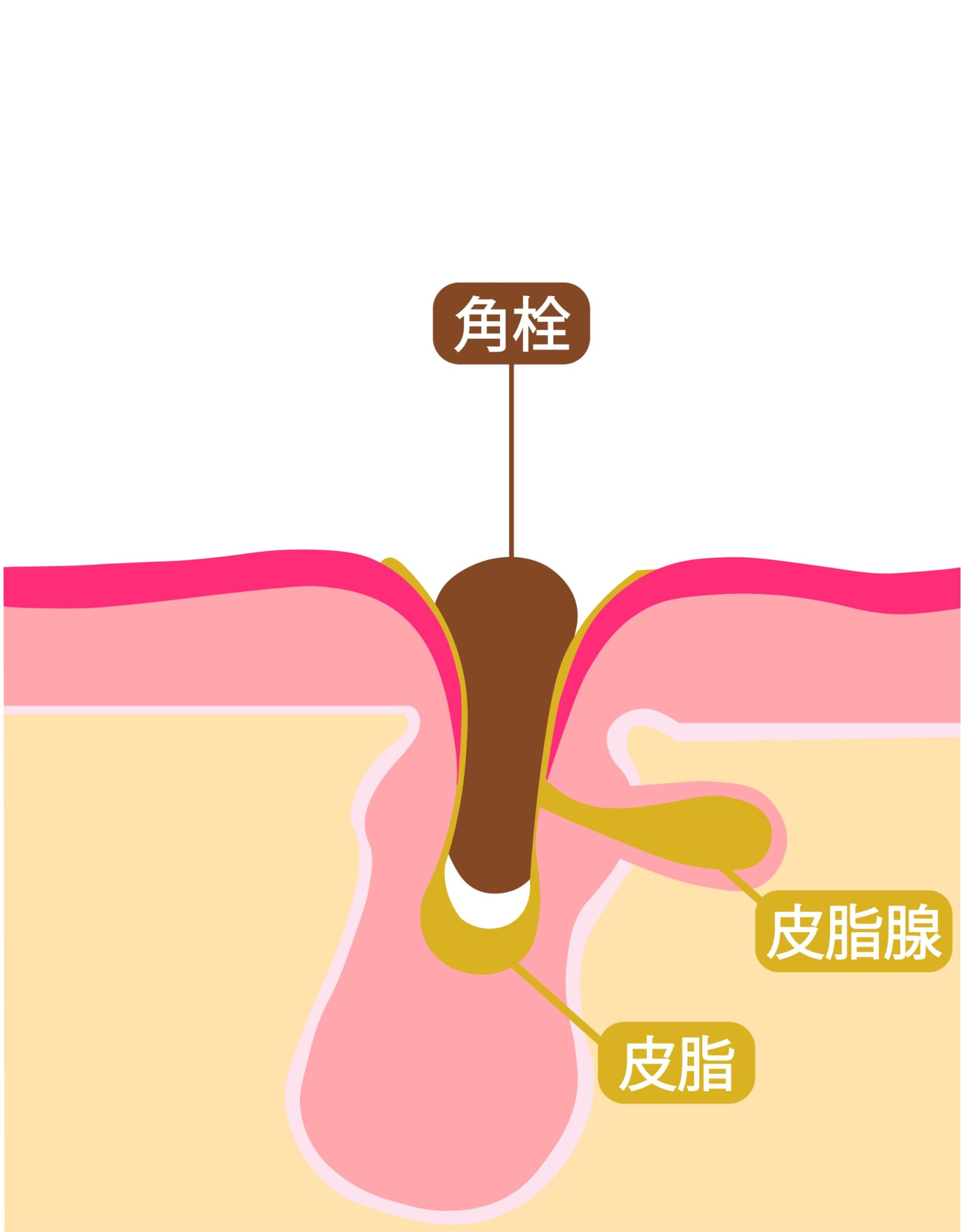 毛穴に角栓が詰まった状態を示す断面図