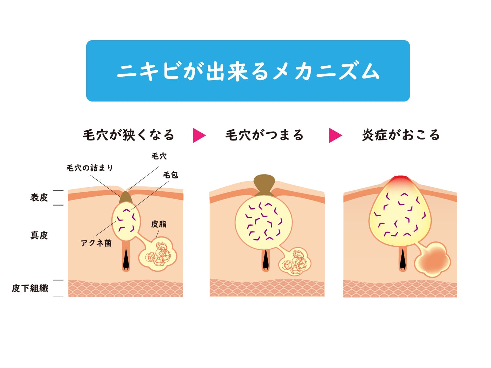 毛穴の出口が詰まり、内部に皮脂がたまり、アクネ菌が増えやすくなって炎症が起こる過程を示す図