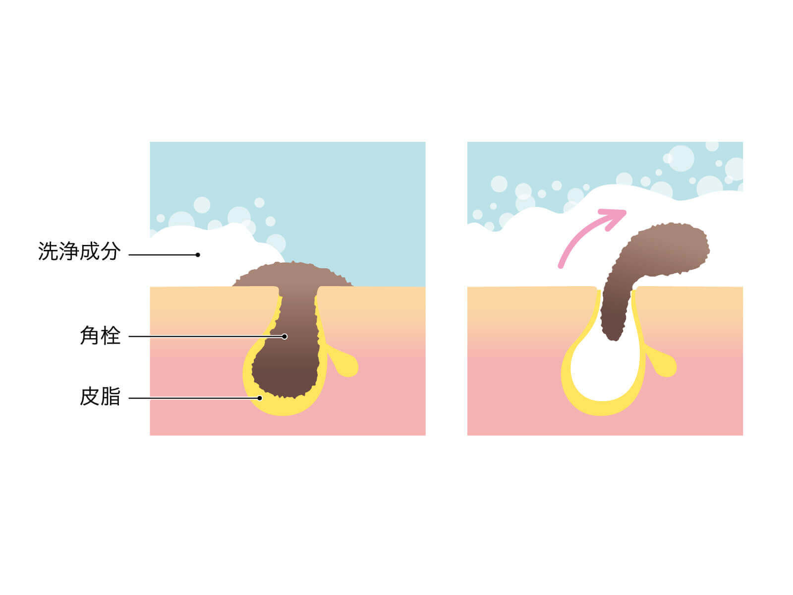 洗浄成分が毛穴の角栓を落とすイメージ図